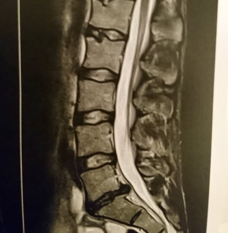 Medical consultation, thorough examination, review of the MRI images, clear diagnosis and recommendation in the case of a herniated disc.